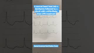 This Is What The Heart Looks Like When It Needs Cpr.