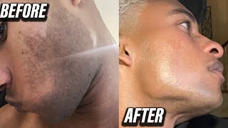 Laser Hair Removal For Men's Beard Shadow UPDATE | Why? What? How?