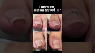 파고드는 통증💥 내성발톱, 그냥 두지 마세요” #내성발톱 #foot #beforeafter  #각질제거 #nails #문제성발톱 #skincare #문제성발톱관리