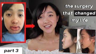 DOUBLE JAW SURGERY changed my life | Before \& After | i hated myself (PART 3)