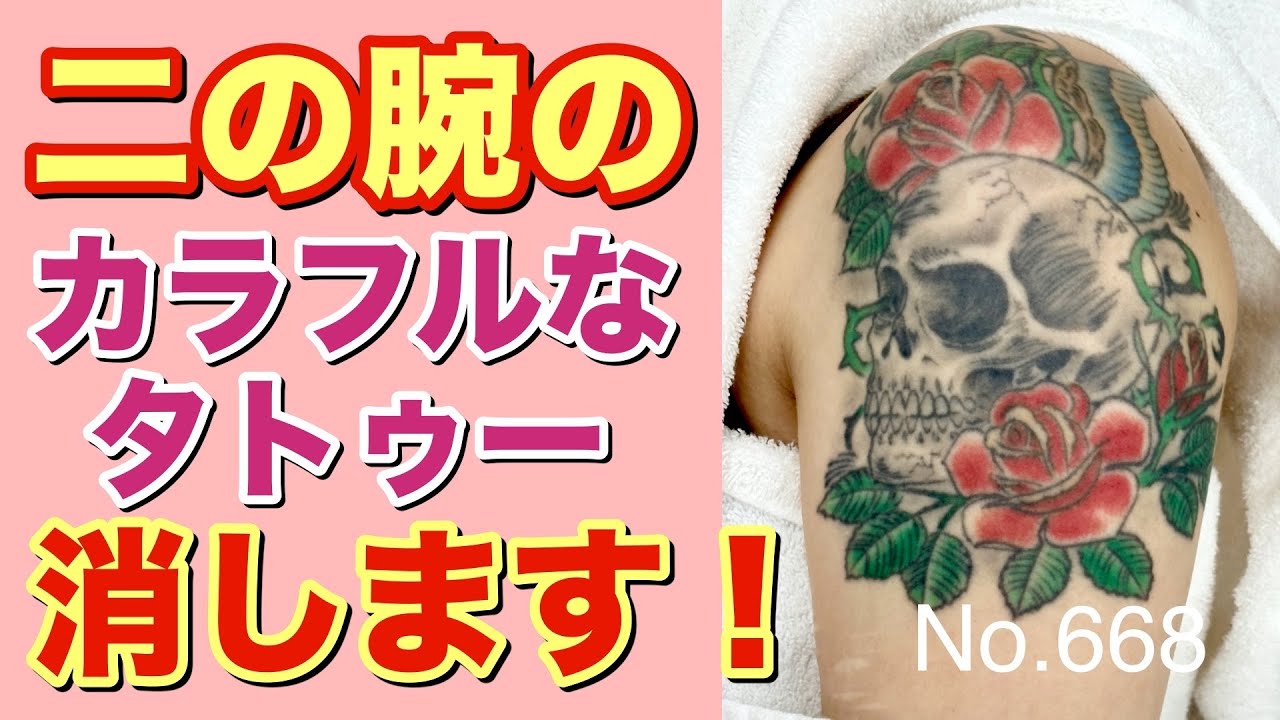 ピコレーザー】カラフルなタトゥー消します！ピコレーザーによる