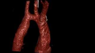 КТ грудной клетки: гипоплазия дуги аорты(http://symptominfo.ru/article/doc/101/ или http://www.medglobus.ru/Medarticles-Angiology-Coarctation%20of%20aorta.htm Здесь Вы можете познакомиться с ..., 2012-03-22T20:15:56.000Z)
