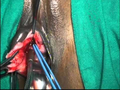 Bartholin cyst, Cyst excision, open cyst excision.