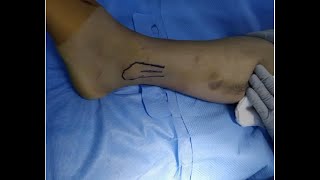 Current Trends in Ankle Fracture Management