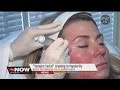 The vampire facial is the hot new trend in staying youthful. #TheNowTampaBay