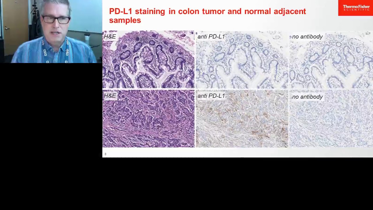 Verifying immunooncology-related gene expression patterns in colon tumor research samples using...