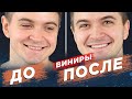 Керамические виниры. Как создается голливудская улыбка? Ceramic veneers.