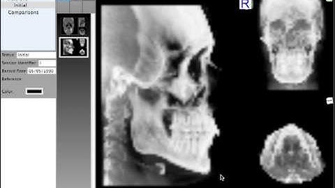 Quick Ceph Studio - Extracting Lateral Frontal SMV Views from CT Scans for Tracing
