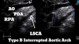 Type B Interrupted Aortic Arch Echocardiography
