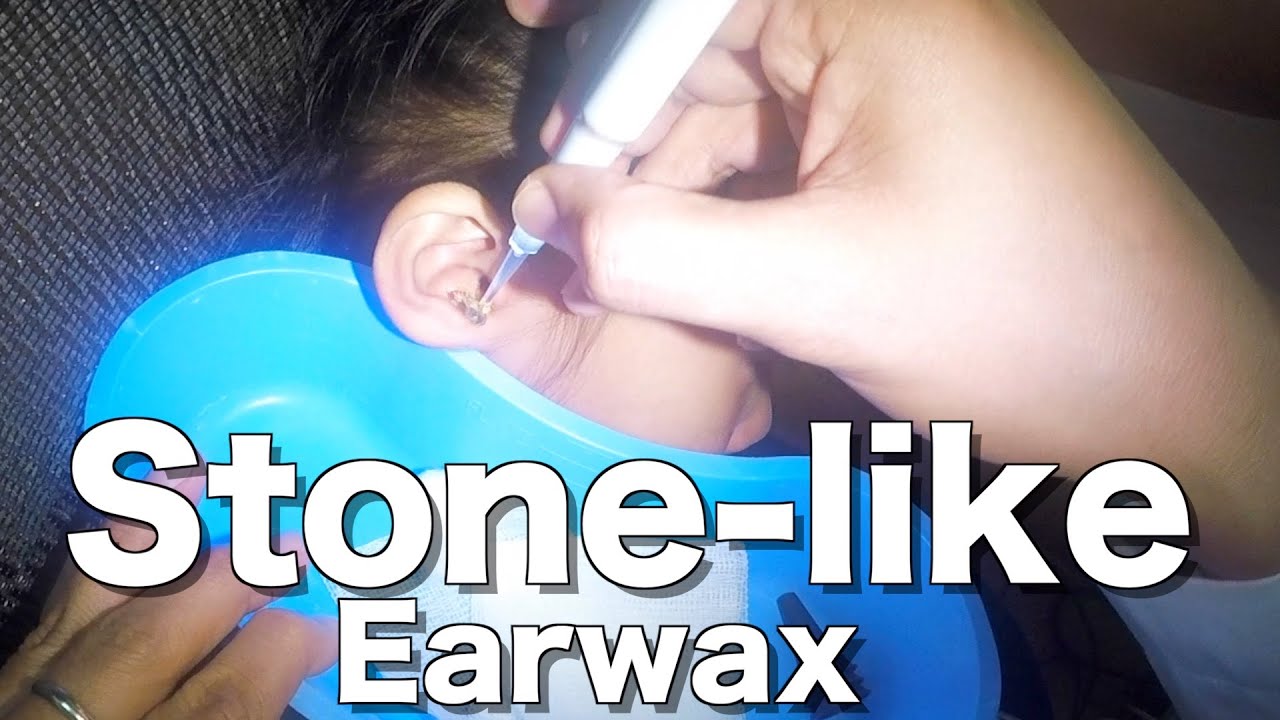 Stonelike Earwax Removal From Little Girl's Ear YouTube