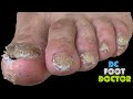 Fungal Toenails Revisited: Follow-up Treatment For The Man With Hard Working Feet