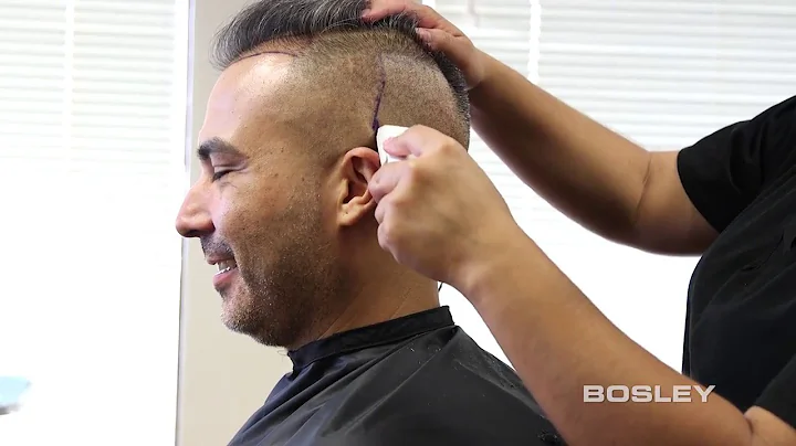 BOSLEY FUE (Follicular Unit Extraction): Hair-by-H...