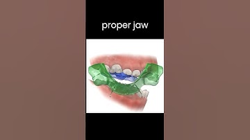Correcting Class II div 1 malocclusion with Twin Block #braces #teeth #dentist #treatment