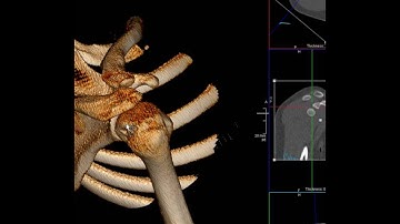 How to do 3D volume rendering of shoulder CT