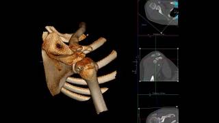 How to do 3D volume rendering of shoulder CT