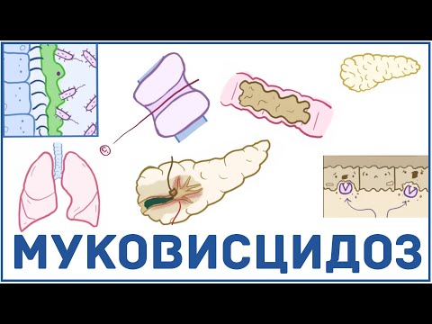 Муковисцидоз - причины, симптомы, диагностика, лечение