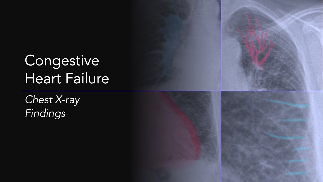 Chest X Ray With Heart Failure