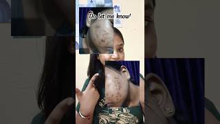 "30 days, no magic—just simple habits. My acne is healing! Want my exact routine? 💬 #acnejourney