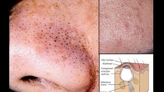HOW BLACKHEADS & ACNE FORM AND HOW TO GET RID OF THEM: DRAW MY LIFE STYLE