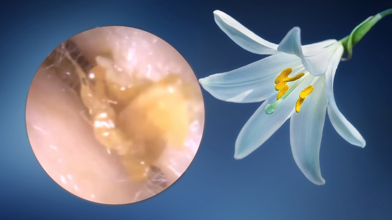 Top Biggest Ear Wax Removal Relaxation 32 YouTube