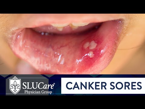 Determining Causes & Treatment for Canker Sores - SLUCare Otolaryngology