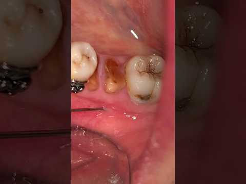 Video: Apakah mencabut gigi itu menyakitkan?
