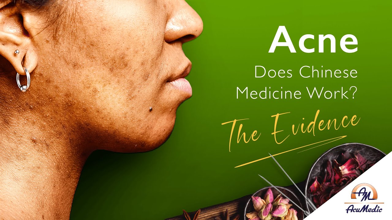 Curing Acne: Is Chinese Medicine the Key to Clear Skin? - YouTube