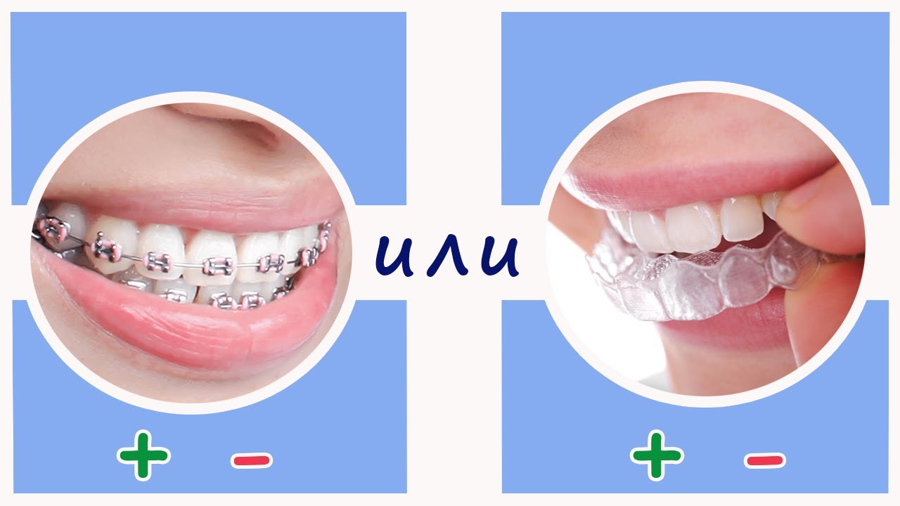 Брекети или алайнери