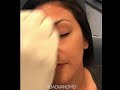 Botox Prevention and Correction