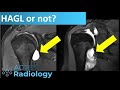 Shoulder MRI - HAGL or iatrogenic extravasation?