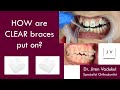 HOW are CLEAR braces put on?  |  Dr. Jiten Vadukul  |  The Orthodontist