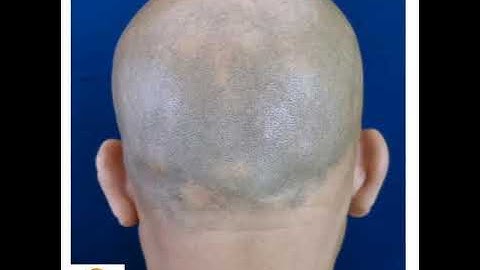 Solution for ALOPECIA... SMP (scalp micropigmentation)