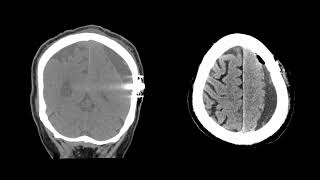 MICAS: A Pilot Study VF NB2