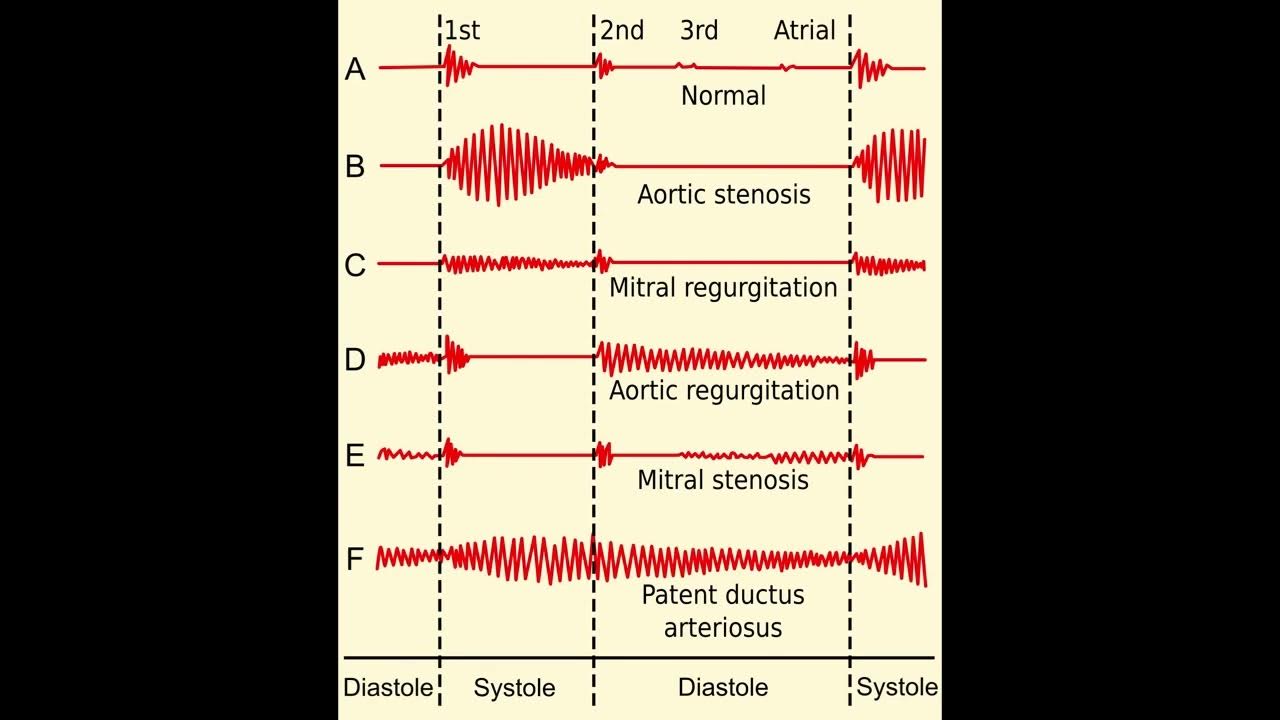types-of-cardiac-murmurs-overview-youtube
