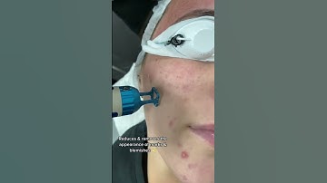 iPixel Laser for acne scarring & big pores | Dr. Medispa