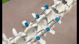 IRENE MIS PLUS Thoracolumbar Spine Fixation System Workshop