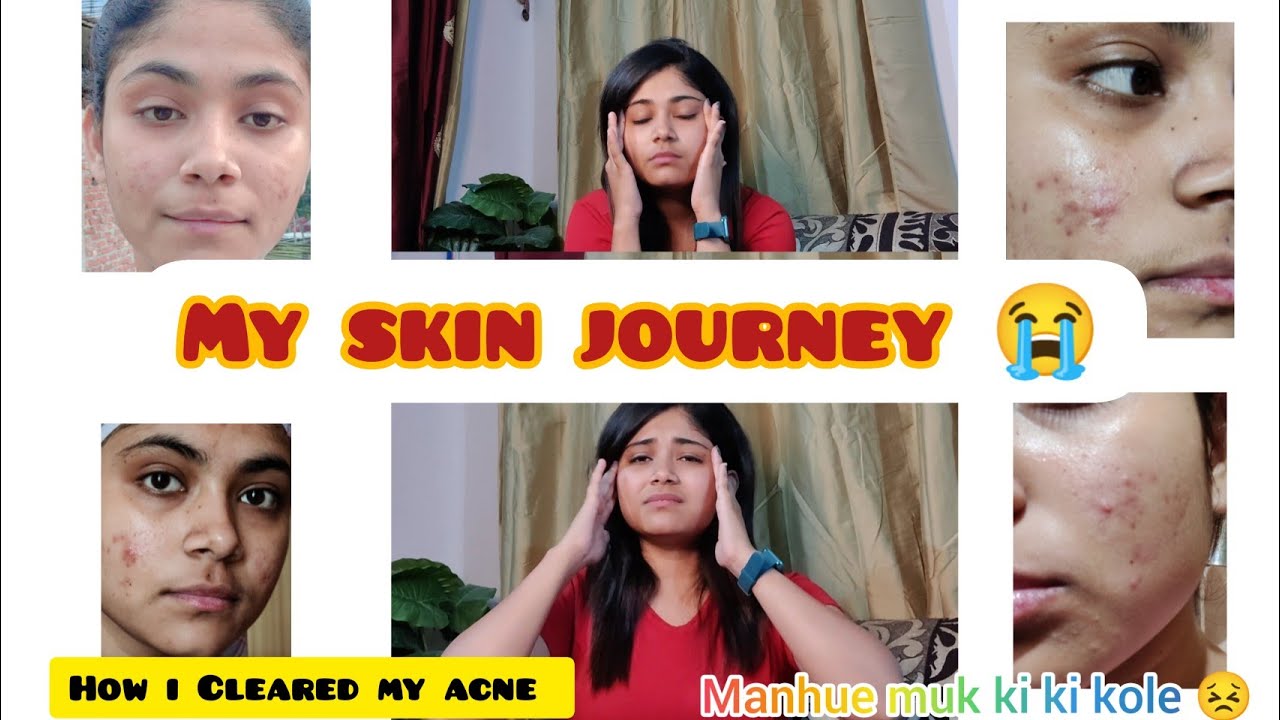 How I Cleared My Acne || My Skin Journey 🙂 - YouTube