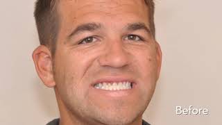 Underbite Surgery Alternative With Jawtrac® Alignment Technology