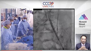 Left SFA ISR Lesion with Prior Failed Intervention  - Peripheral July 2019