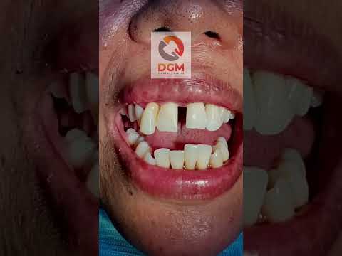 Video: Apakah diastema dalam biologi?