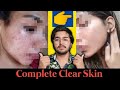 Her Acne Transformation | Acne Satisfying Results Before and After