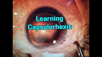 Learning capsulorhexis - Cataract Surgery by Pedro Cabral MD