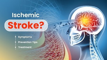Are you at risk of Ischemic Stroke? Symptoms, Prevention Tips, and Treatment - 3D Guide