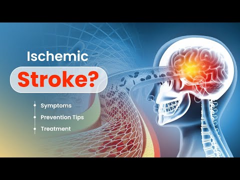 Are you at risk of Ischemic Stroke? Symptoms, Prevention Tips, and Treatment - 3D Guide