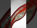 Saving Hearts: One Stent at a Time. See Angioplasty & Stent Placement #stents