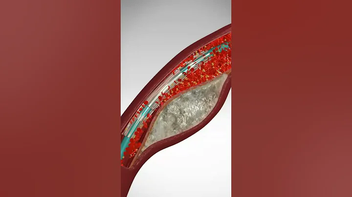 Saving Hearts: One Stent at a Time. See Angioplasty & Stent Placement #stents - DayDayNews