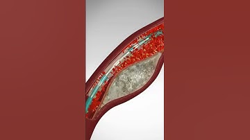 Saving Hearts: One Stent at a Time. See Angioplasty & Stent Placement #stents