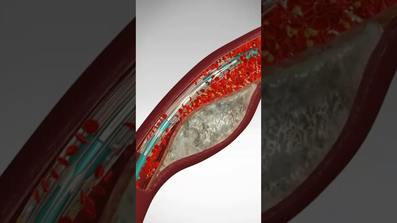 Спасая сердца, по одному стенту за раз: ангиопластика и установка стента