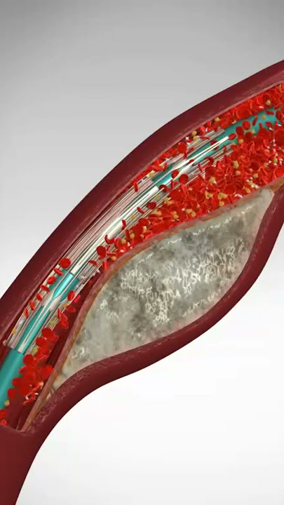 Saving Hearts: One Stent at a Time. See Angioplasty & Stent Placement #stents