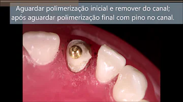 Por quê e quando usar pino Pré-fabricado?